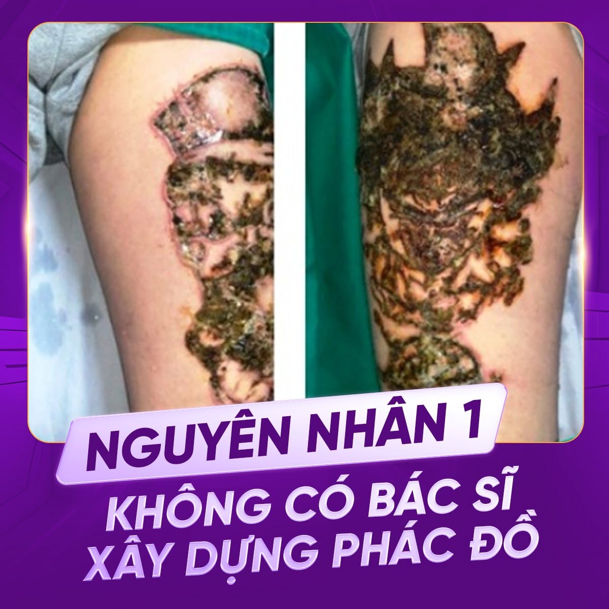 xoá xăm bị bọng nước