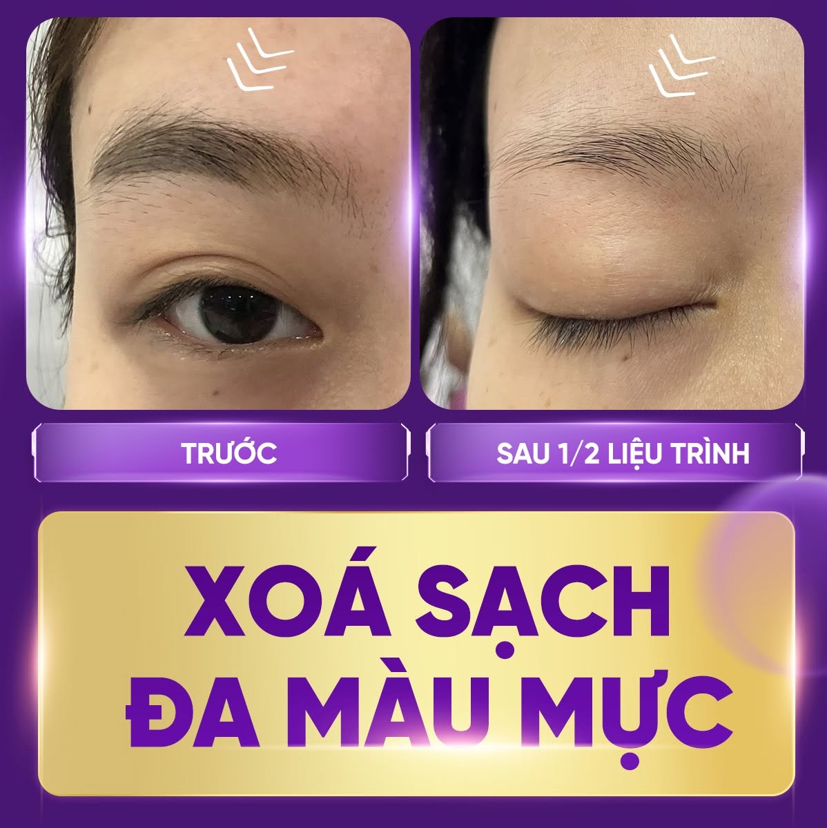 xóa xăm lông mày có bị rụng lông không