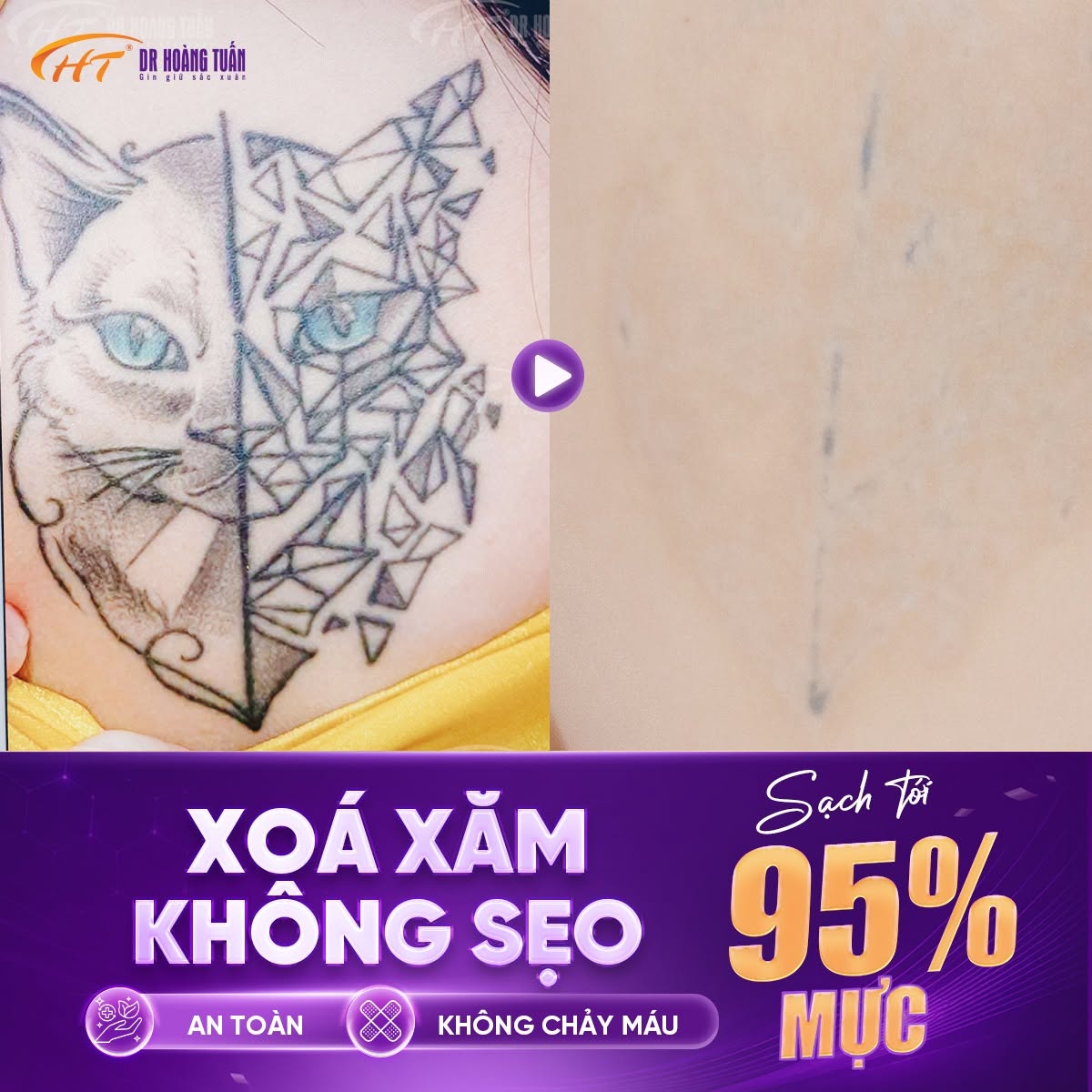 xóa xăm bằng pico laser có hiệu quả không