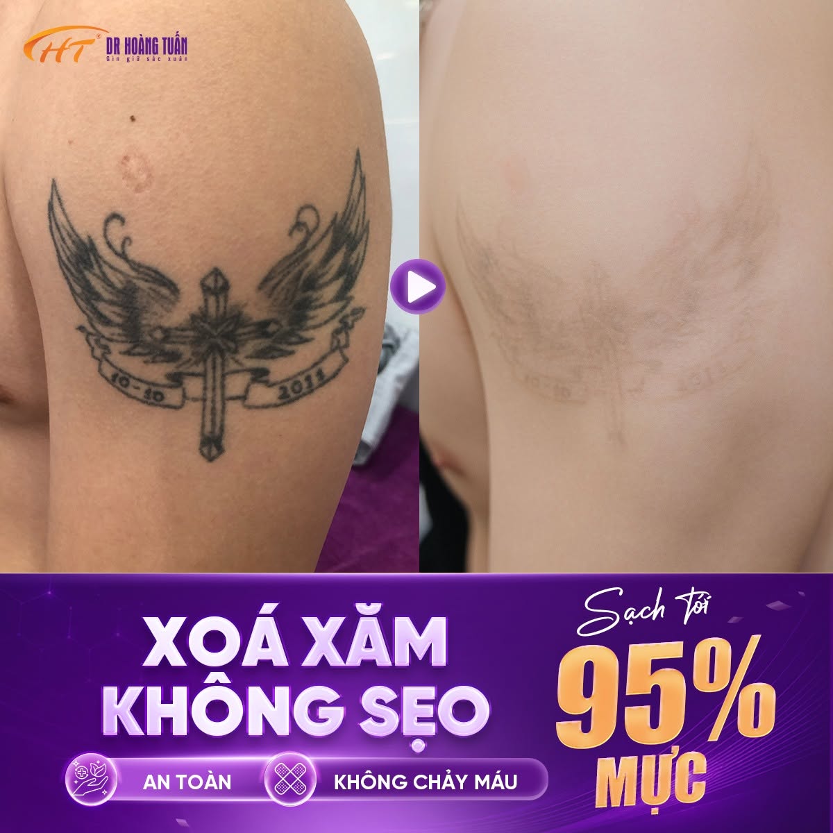 xóa xăm laser có tốt không