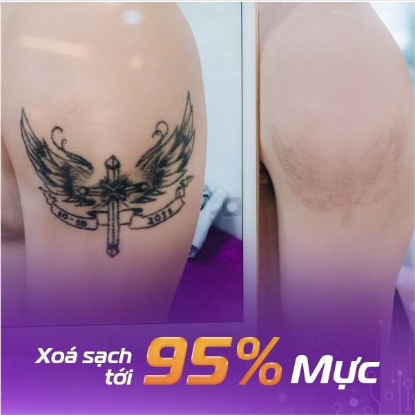 xóa xăm bằng công nghệ laser picosure