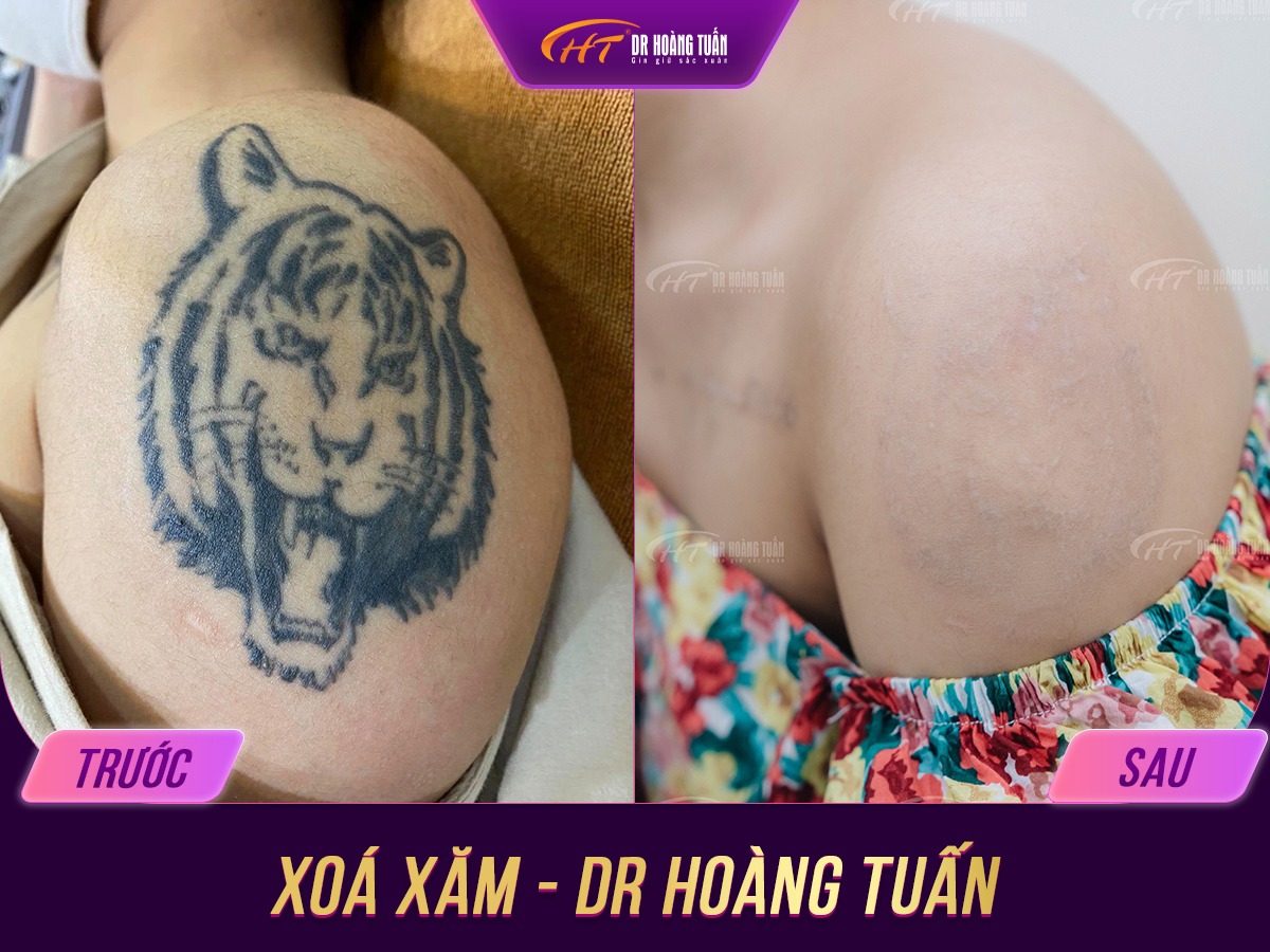 xóa xăm bằng công nghệ laser picosure