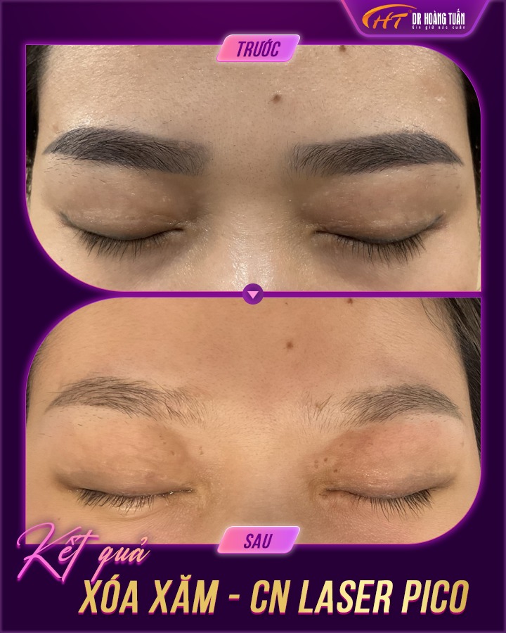 xóa xăm lông mày có bị rụng lông không