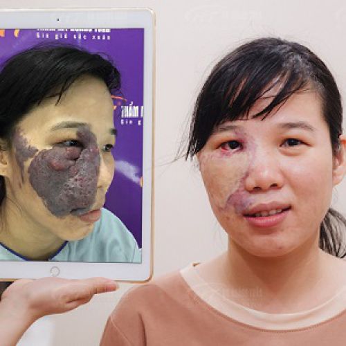 Kết quả Trị u máu