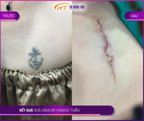 Xoá xăm laser kiêng ăn gì? Một số lưu ý quan trọng cần biết