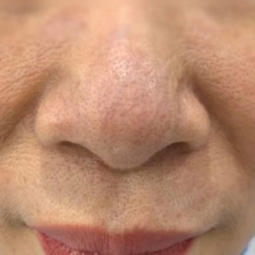 Kết quả Trị Giãn Mao Mạch
