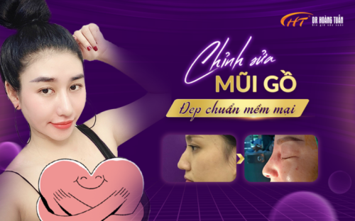 Chỉnh Sửa Mũi Gồ
