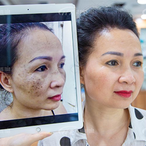 Kết quả Trị Nám & Tàn nhang