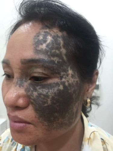 Biến chứng do điều trị bớt sắc tố sai cách