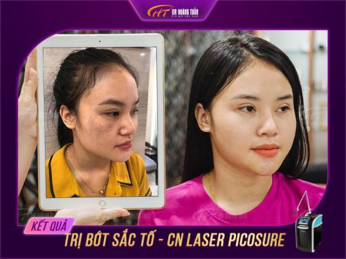 Bớt sắc tố nâu và cách điều trị bớt sắc tố bằng công nghệ laser tại Dr Hoàng Tuấn