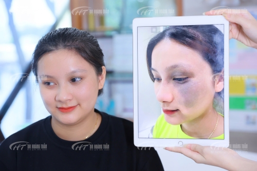 Chi phí điều trị bớt sắc tố hiện nay là bao nhiêu? Những yếu tố ảnh hưởng