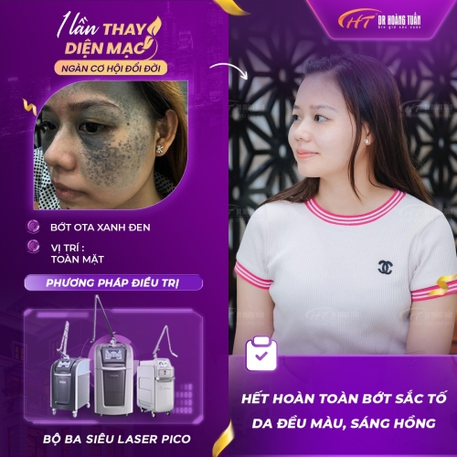 Kết quả Trị bớt sắc tố
