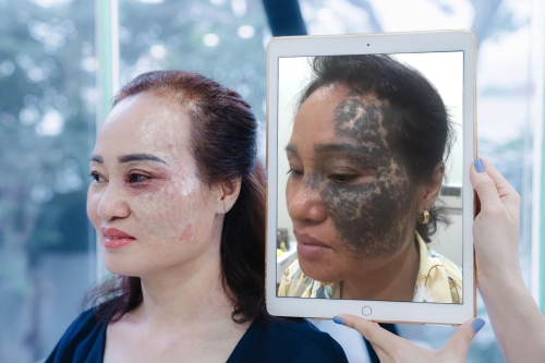 Vết bớt có ý nghĩa gì? Vết bớt có điều trị được hết không?