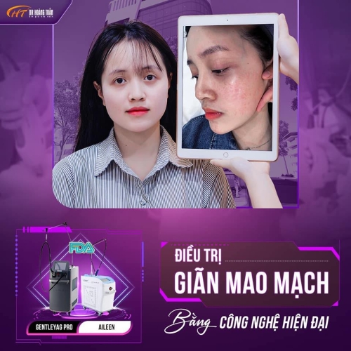 Giãn mao mạch có nguy hiểm không? Điều trị giãn mao mạch như thế nào?