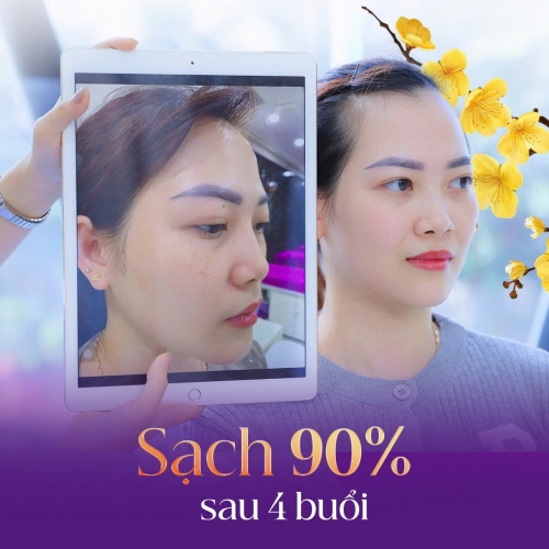 Điều trị tàn nhang có hết không? Chuyên gia da liễu giải đáp