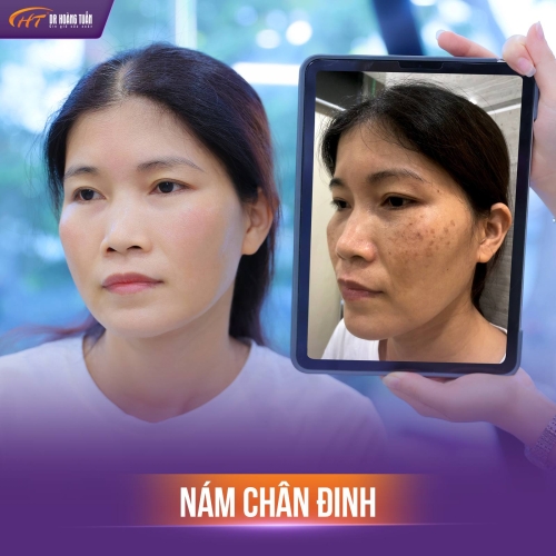 Điều trị nám mất bao lâu? Những yếu tố quyết định thời gian