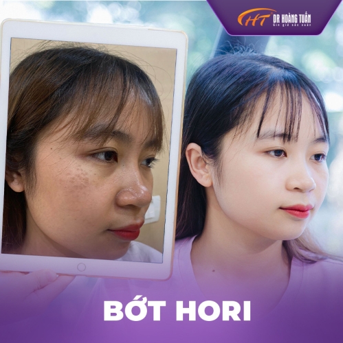 Bớt sắc tố hori và những điều bạn nên biết
