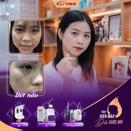 Những điều cần biết trong điều trị bớt sắc tố cafe