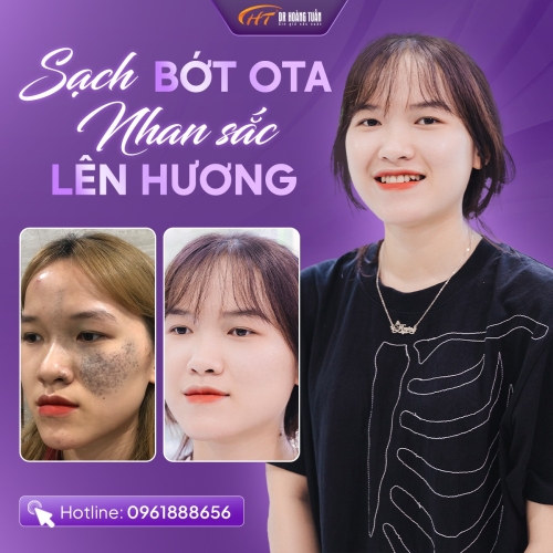 Bớt sắc tố ota và những điều bạn cần biết