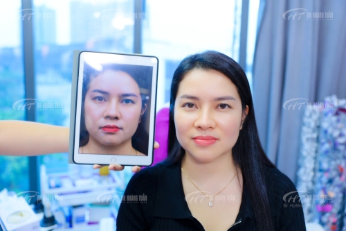 Căng chỉ nọng cằm - Giải pháp xóa nọng cằm không phẫu thuật