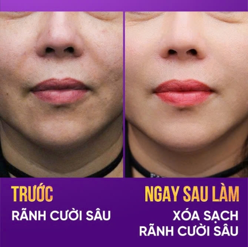 Căng chỉ rãnh mũi má giúp trẻ hóa khuôn mặt như thế nào?