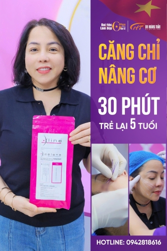 Nên tiêm filler hay căng chỉ? So sánh chi tiết 2 phương pháp