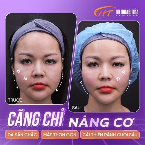 Nâng cơ mặt bằng chỉ - giải pháp trẻ hóa da an toàn và hiệu quả