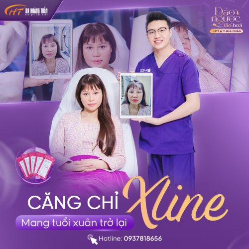 Căng chỉ nâng cơ mặt có hiệu quả không? Giải đáp từ chuyên gia