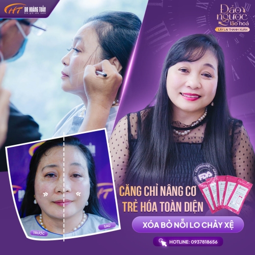 Căng chỉ da mặt là gì? Có giúp trẻ hóa và nâng cơ không?