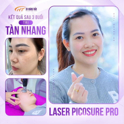Điều trị nám bằng laser bao nhiêu lần thì hết? Giải đáp chi tiết