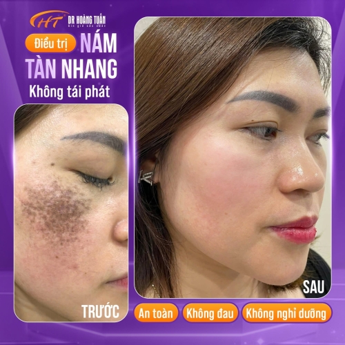 Tàn nhang có chữa được không? Cách điều trị hiệu quả hiện nay