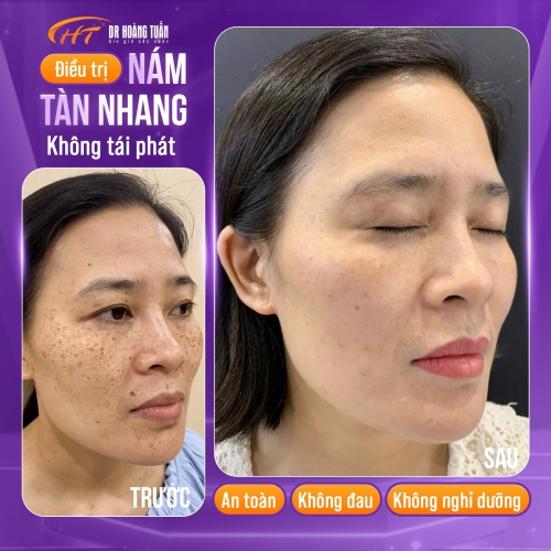 Phân biệt đồi mồi và tàn nhang khác nhau như thế nào?