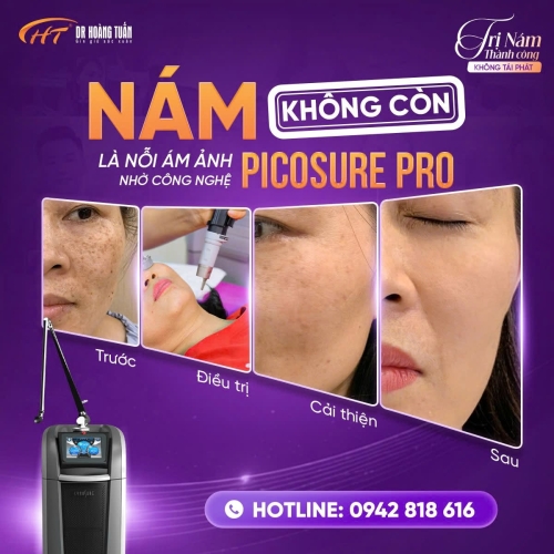 Nám khác tàn nhang như nào? Dấu hiệu giúp phân biệt dễ dàng