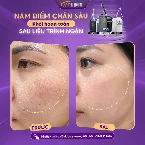 Nám da nhẹ có tự hết không? Cách cải thiện hiệu quả