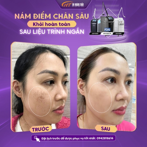 Da bắt đầu bị nám: Dấu hiệu nhận biết và cách ngăn nám lan rộng