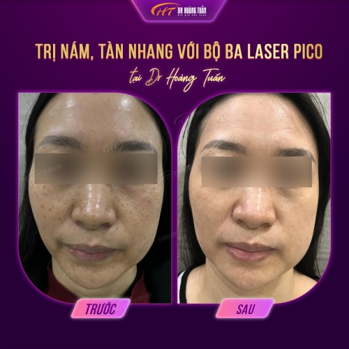 Nám da tuổi 40 - Nguyên nhân và giải pháp
