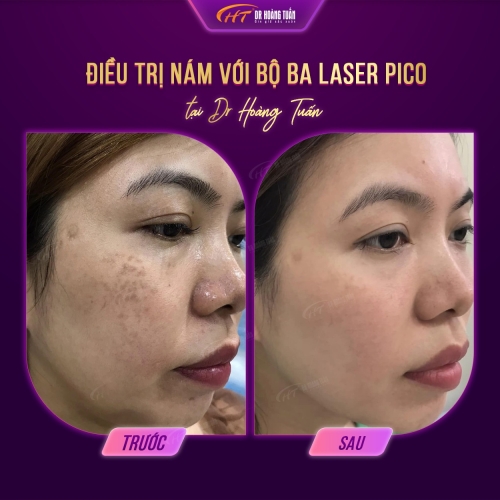 Nám da có di truyền không? Nám di truyền có chữa được không?