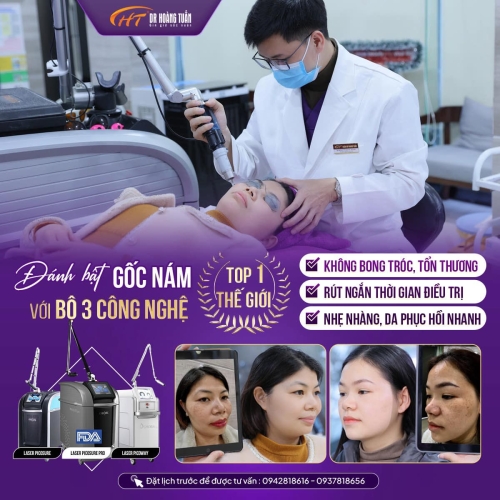 Điều trị nám da