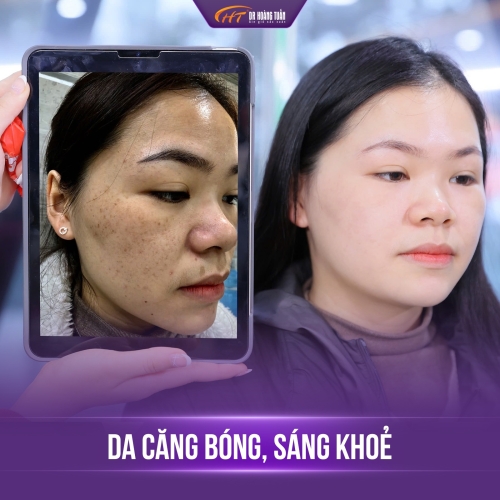 Nám đốm là gì? Nguyên nhân và cách điều trị hiệu quả