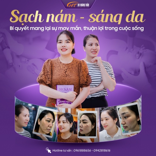 Nám quanh mắt là gì? Vì sao vùng da quanh mắt dễ bị nám?
