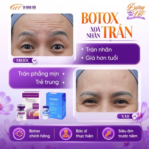 Tiêm botox xóa nhăn bao lâu có hiệu quả và duy trì được bao lâu?