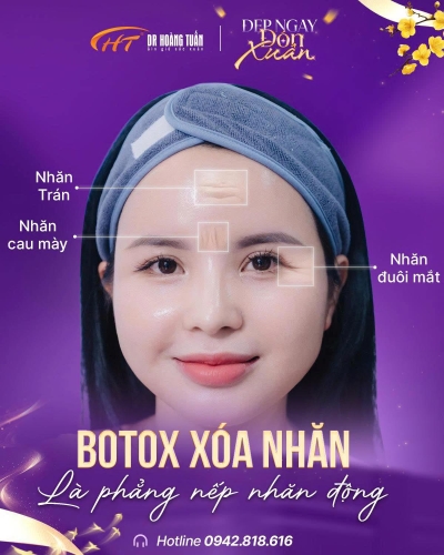 Tiêm Botox xóa nhăn giữ được bao lâu? Những yếu tố ảnh hưởng