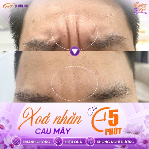 Tiêm botox xóa nhăn cau mày: Giải pháp trẻ hóa không cần phẫu thuật