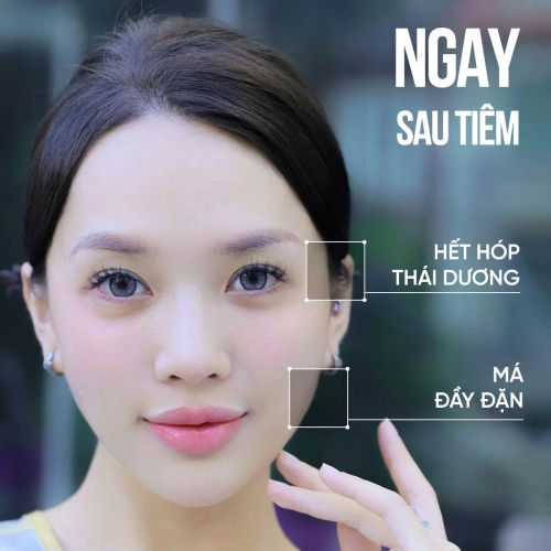 Bác sĩ giải đáp thắc mắc tiêm filler duy trì được bao lâu?