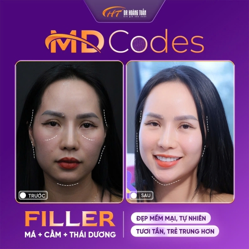 Tiêm filler má bao lâu thì vào form? Các giai đoạn phục hồi