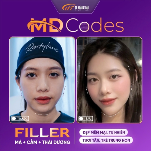 Tiêm filler có an toàn không? Có nguy hiểm không?