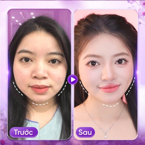 Tiêm Filler môi có ảnh hưởng gì không? Tìm hiểu trước khi thực hiện