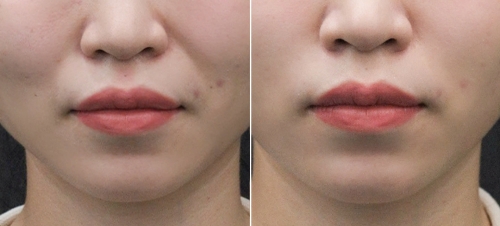 Tiêm Filler môi bao lâu hết sưng? Cách giảm sưng nhanh, an toàn