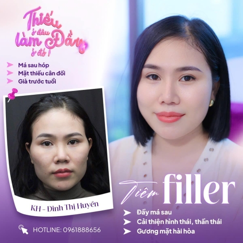 Tiêm Filler bị ngứa có sao không? Bác sĩ thẩm mỹ giải đáp