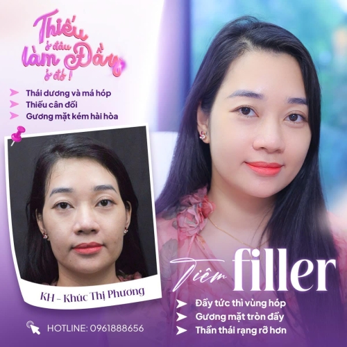 Tiêm filler má hóp giúp gương mặt trẻ hơn chỉ sau 15 phút